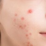 A detailed close-up of a woman's face showing acne blemishes on her skin.